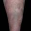 73. Venous Eczema on Legs Pictures
