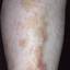 75. Venous Eczema on Legs Pictures