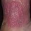 76. Venous Eczema on Legs Pictures
