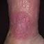 77. Venous Eczema on Legs Pictures