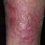 80. Venous Eczema on Legs Pictures