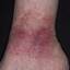 81. Venous Eczema on Legs Pictures