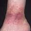 82. Venous Eczema on Legs Pictures