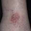 83. Venous Eczema on Legs Pictures