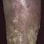 84. Venous Eczema on Legs Pictures