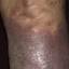 85. Venous Eczema on Legs Pictures
