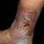 86. Venous Eczema on Legs Pictures