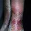 87. Venous Eczema on Legs Pictures
