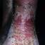 88. Venous Eczema on Legs Pictures