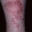 89. Venous Eczema on Legs Pictures