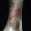 9. Venous Eczema on Legs Pictures