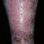 90. Venous Eczema on Legs Pictures