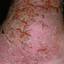 91. Venous Eczema on Legs Pictures