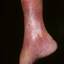 93. Venous Eczema on Legs Pictures
