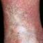 94. Venous Eczema on Legs Pictures