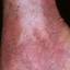 95. Venous Eczema on Legs Pictures