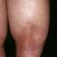 96. Venous Eczema on Legs Pictures