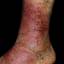 97. Venous Eczema on Legs Pictures