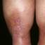 98. Venous Eczema on Legs Pictures
