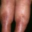 99. Venous Eczema on Legs Pictures