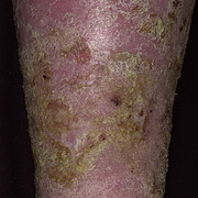 Venous Eczema