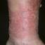 105. Venous Eczema Pictures