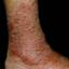 106. Venous Eczema Pictures