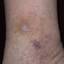 116. Venous Eczema Pictures