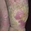 135. Venous Eczema Pictures