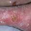 145. Venous Eczema Pictures