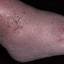 8. Venous Eczema Pictures