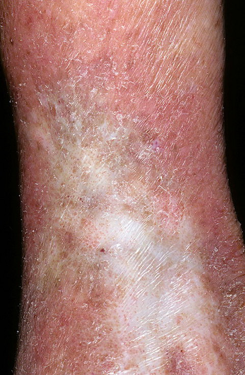 Venous Eczema Pictures 174 Photos Images Illnessee Com