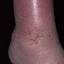10. Stasis Dermatitis Pictures