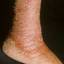 102. Stasis Dermatitis Pictures