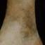 108. Stasis Dermatitis Pictures