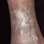 129. Stasis Dermatitis Pictures