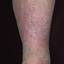 133. Stasis Dermatitis Pictures