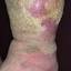 134. Stasis Dermatitis Pictures