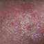 136. Stasis Dermatitis Pictures