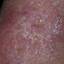 137. Stasis Dermatitis Pictures