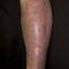 142. Stasis Dermatitis Pictures