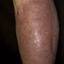 144. Stasis Dermatitis Pictures
