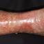 167. Stasis Dermatitis Pictures