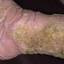 174. Stasis Dermatitis Pictures