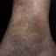 25. Stasis Dermatitis Pictures