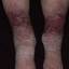 50. Stasis Dermatitis Pictures