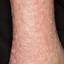 54. Stasis Dermatitis Pictures