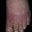 65. Stasis Dermatitis Pictures