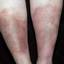72. Stasis Dermatitis Pictures