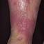 78. Stasis Dermatitis Pictures